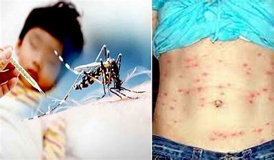 मकवानपुरमा २३ जना डेंगु र ७ जना स्क्रब टाइफसका बिरामी भेटिए